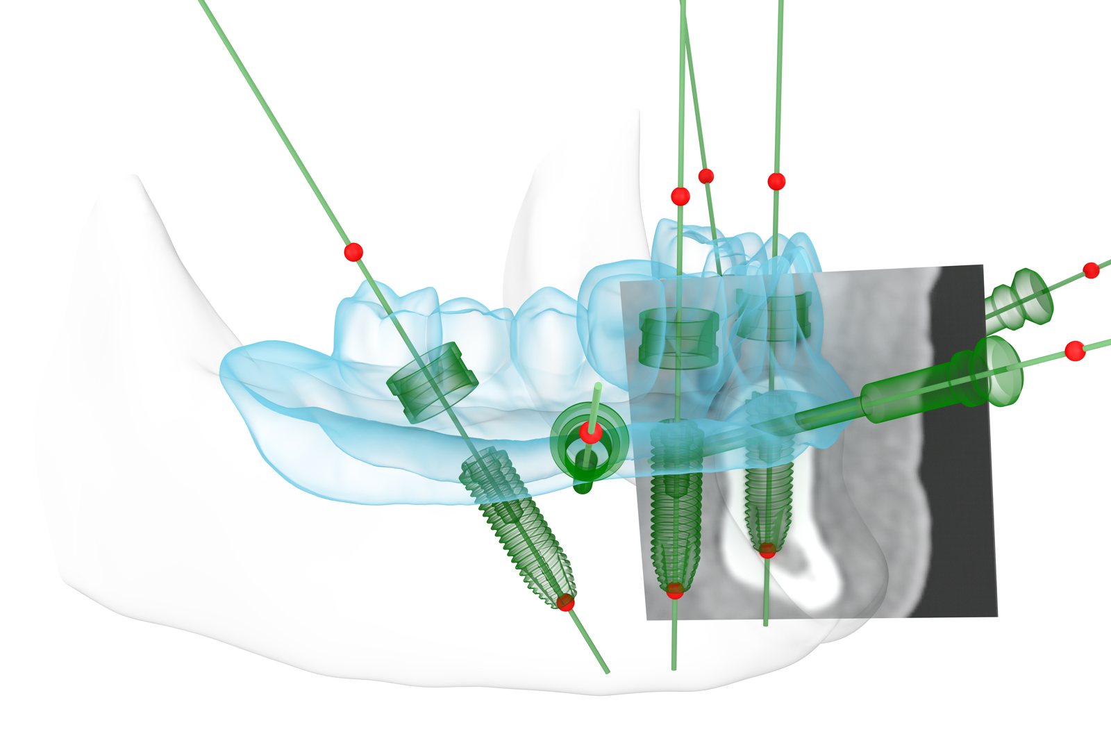Illustration: 3D-Planung der Implantatpositionen am Computer