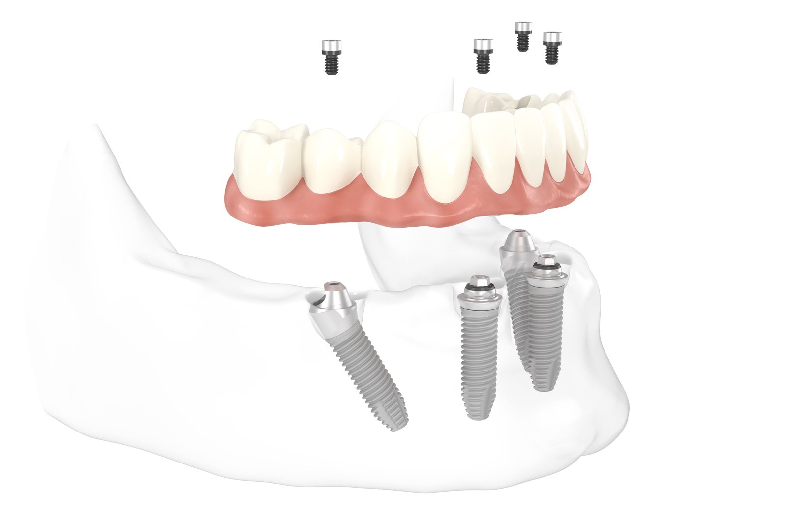 All-on-4: feste Brücke auf vier Implantaten im Unterkiefer